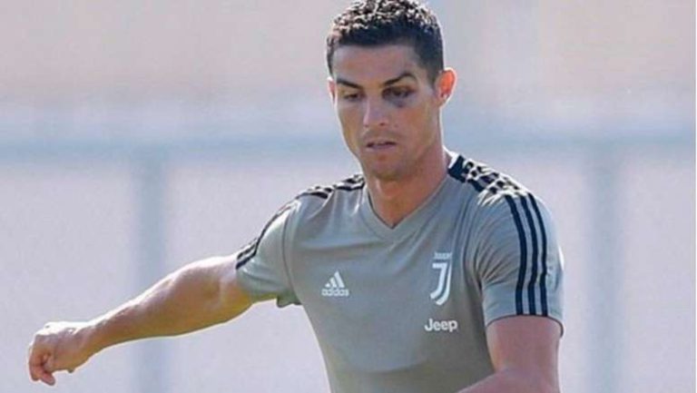 Cristiano Ronaldo Aparece Con Un Ojo Morado A Entrenar Con La Juve